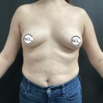 Breast Augmentation Before & After Patient #15685
