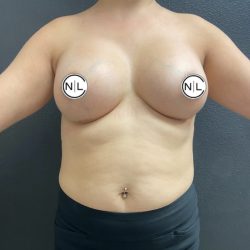 Breast Augmentation Before & After Patient #15685