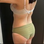 Brazilian Butt Lift Before & After Patient #15647