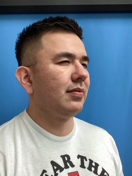 Jawline/Neck - For Men Before & After Patient #15577