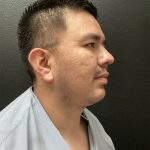 Jawline/Neck - For Men Before & After Patient #15577