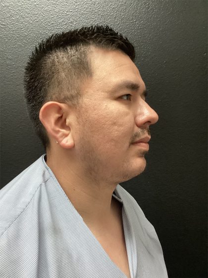 Jawline/Neck - For Men Before & After Patient #15577