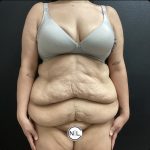 Abdominoplasty Before & After Patient #15587