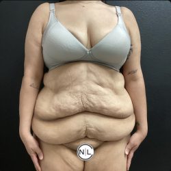 Abdominoplasty Before & After Patient #15587