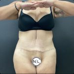 Abdominoplasty Before & After Patient #15587