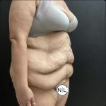 Abdominoplasty Before & After Patient #15587