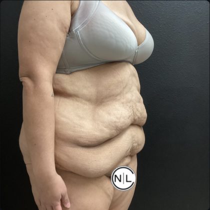 Abdominoplasty Before & After Patient #15587