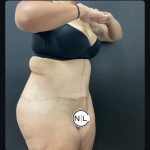 Abdominoplasty Before & After Patient #15587