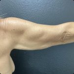 Brachioplasty Before & After Patient #15578
