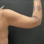 Brachioplasty Before & After Patient #15578