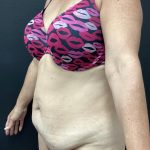 Abdominoplasty Before & After Patient #15722