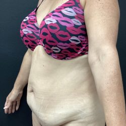 Abdominoplasty Before & After Patient #15722