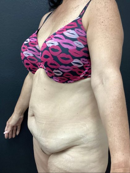 Abdominoplasty Before & After Patient #15722