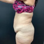 Abdominoplasty Before & After Patient #15722