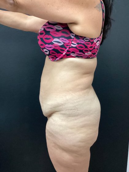 Abdominoplasty Before & After Patient #15722