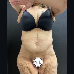 Abdominoplasty Before & After Patient #15733