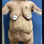 Abdominoplasty Before & After Patient #15733