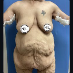 Abdominoplasty Before & After Patient #15733