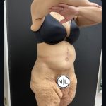 Abdominoplasty Before & After Patient #15733