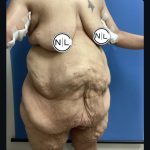 Abdominoplasty Before & After Patient #15733
