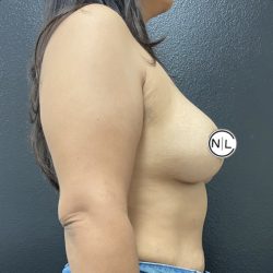 Breast Augmentation Before & After Patient #15734