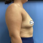 Breast Augmentation Before & After Patient #15734