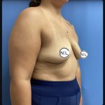 Breast Augmentation Before & After Patient #15734
