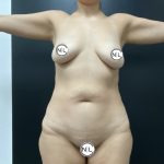 Breast Augmentation Before & After Patient #15735