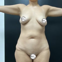 Breast Augmentation Before & After Patient #15735