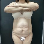 Abdominoplasty Before & After Patient #15748
