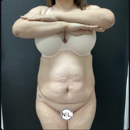 Abdominoplasty Before & After Patient #15748
