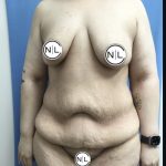 Abdominoplasty Before & After Patient #15749