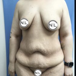 Abdominoplasty Before & After Patient #15749