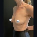 Breast Augmentation Before & After Patient #15750