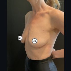 Breast Augmentation Before & After Patient #15750