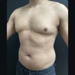 Gynecomastia Before & After Patient #15751