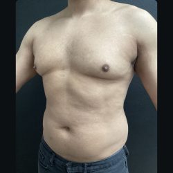 Gynecomastia Before & After Patient #15751