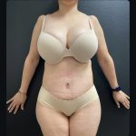 Abdominoplasty Before & After Patient #15748