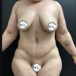 Abdominoplasty Before & After Patient #15749