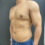 Gynecomastia Before & After Patient #15751