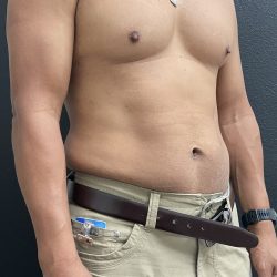Weight Loss Before & After Patient #15754