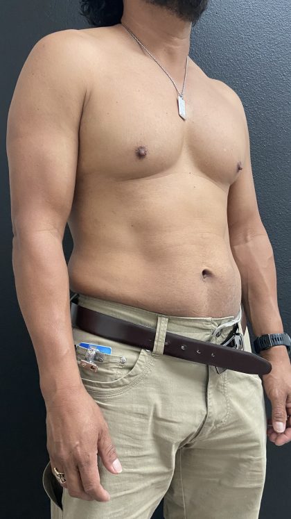 Weight Loss Before & After Patient #15754