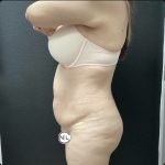 Abdominoplasty Before & After Patient #15748