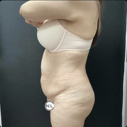 Abdominoplasty Before & After Patient #15748