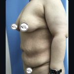 Abdominoplasty Before & After Patient #15749