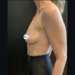 Breast Augmentation Before & After Patient #15750