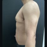 Gynecomastia Before & After Patient #15751
