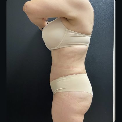 Abdominoplasty Before & After Patient #15748