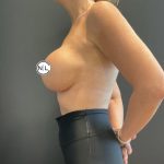 Breast Augmentation Before & After Patient #15750