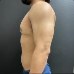 Gynecomastia Before & After Patient #15751